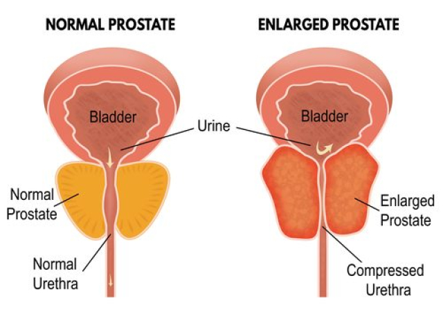 Kako nastaje uvećana prostata - simptomi uvećanja prostate
