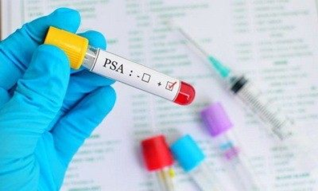 Šta je PSA tumor marker prostate i kako se meri