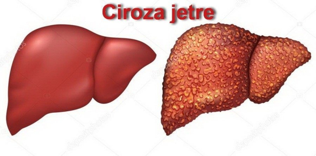 Kako nastaje ciroza jetre - uzroci ciroze jetre