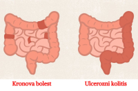 Razlike između ulceroznog kolitisa i Kronove bolesti