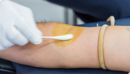 Lugolova otopina i kako se meri nedostatak joda na koži - Patch test Iodine