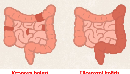 Razlike između ulceroznog kolitisa i Kronove bolesti