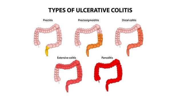 Tipovi Ulcerozni Kolitis i Kronova bolest, simptomi i lečenje Ulceroznog kolitisa