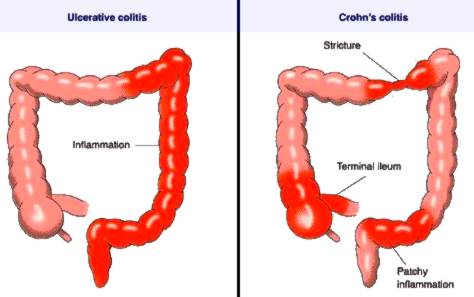 Ulcerozni Kolitis i Kronova bolest, uzroci i simptomi i lečenje Ulceroznog kolitisa