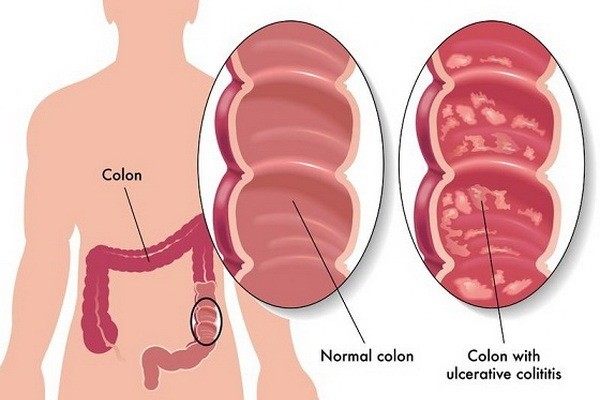 Ishrana i dijeta za Ulcerozni kolitis - koja hrana se jede kod kolitisa