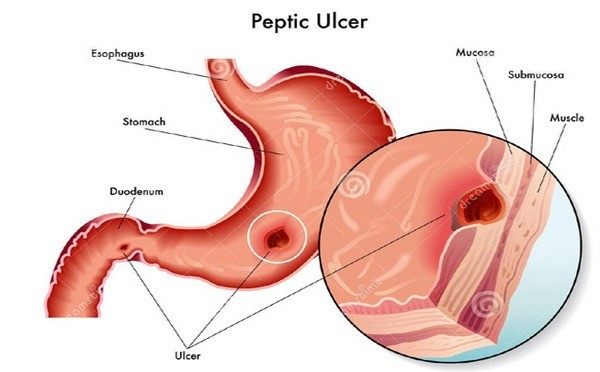 Peptički ulkus - čir na želucu i dvanaestopalačnom crevu