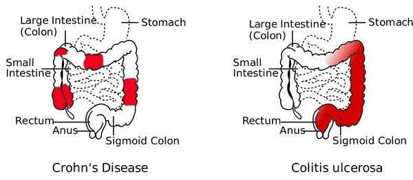 Ulcerozni kolitis i ishrana - kako se hraniti kod Ulceroznog kolitisa
