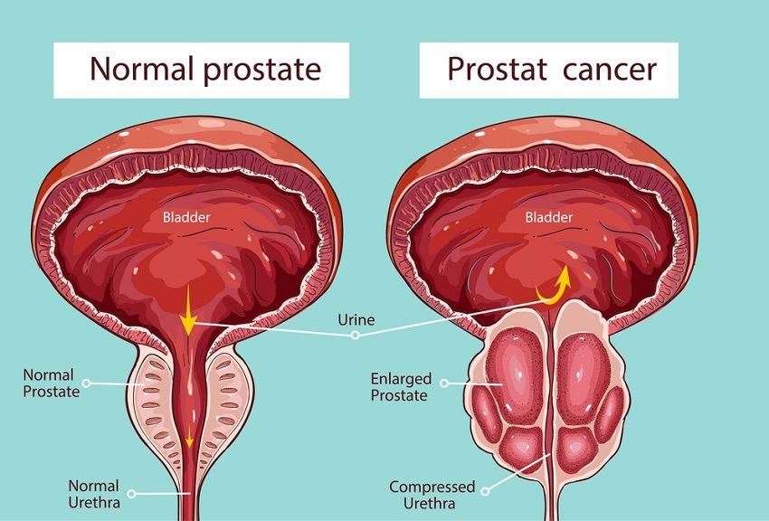 Veličina prostate i godine starosti - uvećana prostata i normalne mere za prostatu