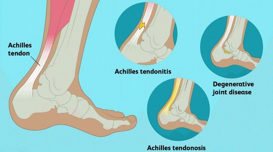 Ahilova tetiva (tendo Achillis) i ruptura  - kako nastaje puknuće Ahilove tetive