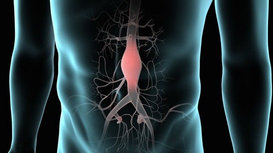 Šta je aneurizma trbušne aorte i koji su simptomi?